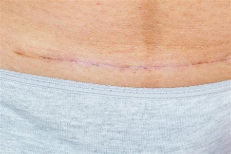 According to Research Gate, this is rare but it can happen. . Why does my csection scar itch after 20 years